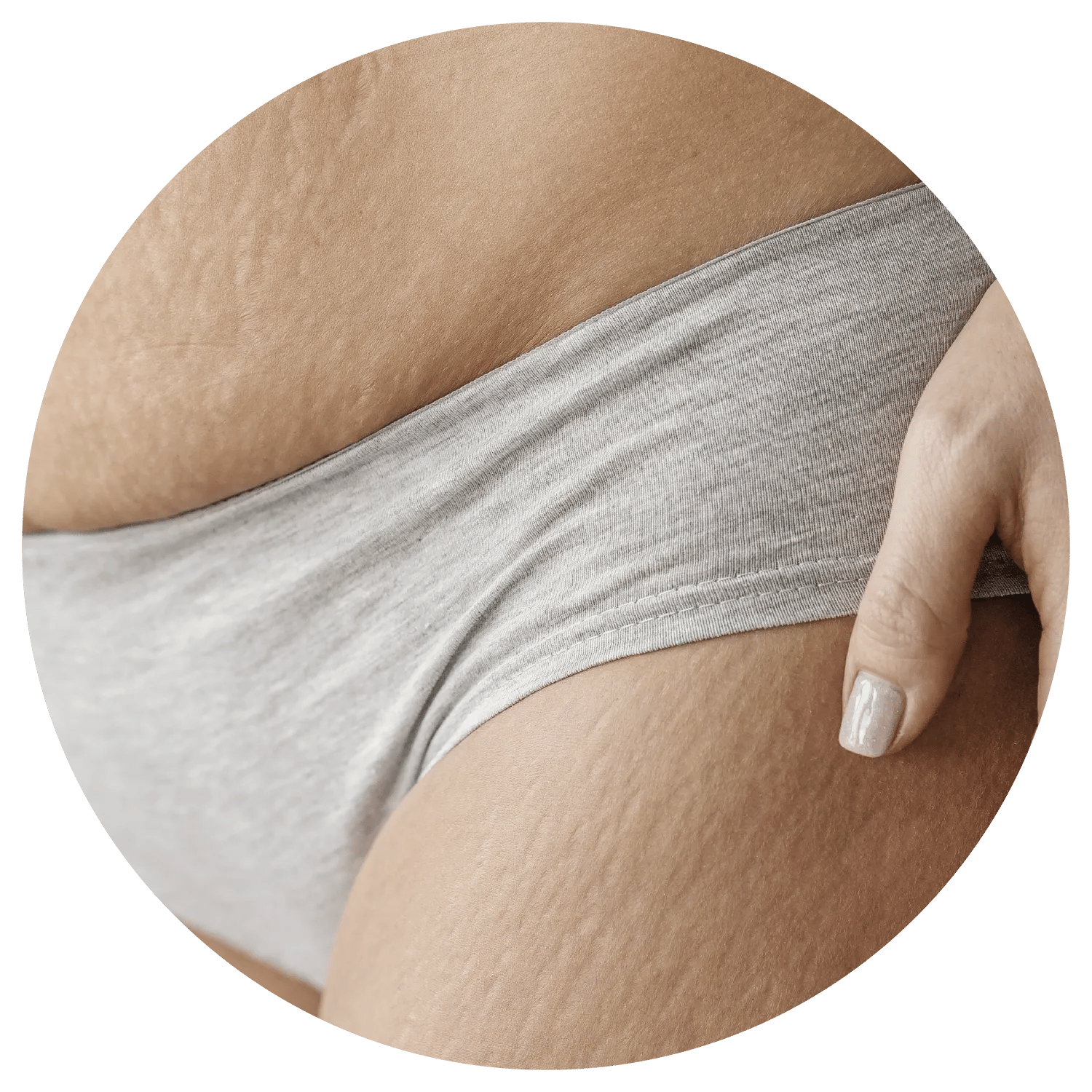 Stretch Marks treatment process at Toronto medical spa - Understand what's beneath the stretch.